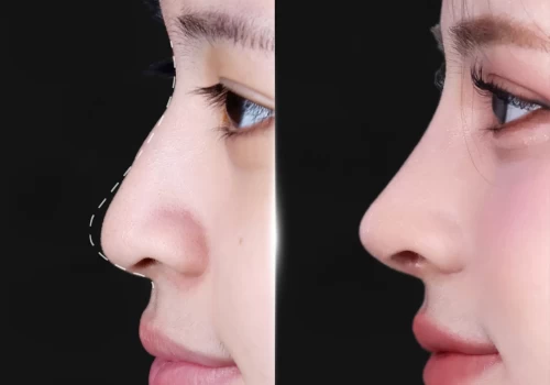 Những yếu tố ảnh hưởng đến kết quả thẩm mỹ mà ít người để ý