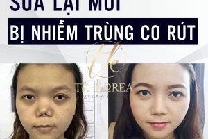 Mũi Nhiễm Trùng Co Rút