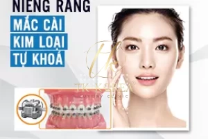 Niềng răng mắc cài kim loại tự khoá