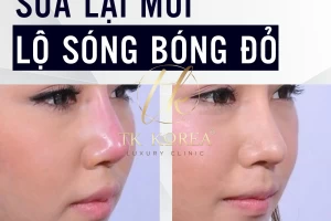 Sửa Lại Mũi Lộ Sóng Bóng Đỏ