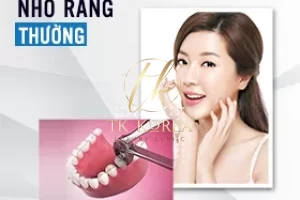 Nhổ răng thường