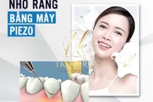 Nhổ răng bằng máy Piezo - Răng mọc lệch