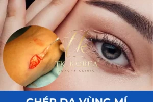 Ghép Da Vùng Mí