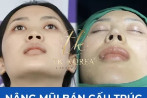 Nâng mũi bán cấu trúc