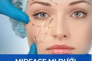 Midface mí dưới