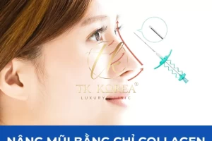 Nâng mũi bằng chỉ Collagen
