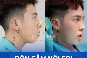 Độn Cằm Nội Soi