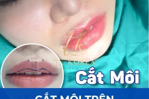 Cắt môi trên