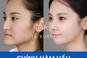 Tạo Hình Chỉnh Hàm Vẩu