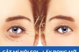 Cắt Mí Dưới - Nội Soi Lấy Bọng Mỡ