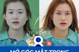 Mở góc mắt trong