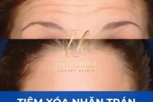 Tiêm xoá nếp nhăn trán